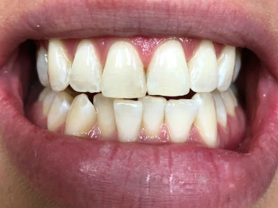 teeth bleaching