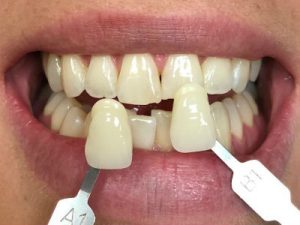 teeth bleaching treatment