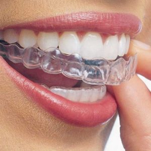 Invisalign in Barrie, Orthodontic Treatment in Barrie